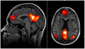 MRT-Bild des Gehirns mit hervorgehobenen Bereichen des Default-Mode-Networks in Rot.